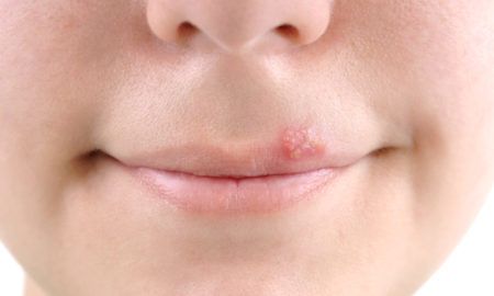 herpes.jpg