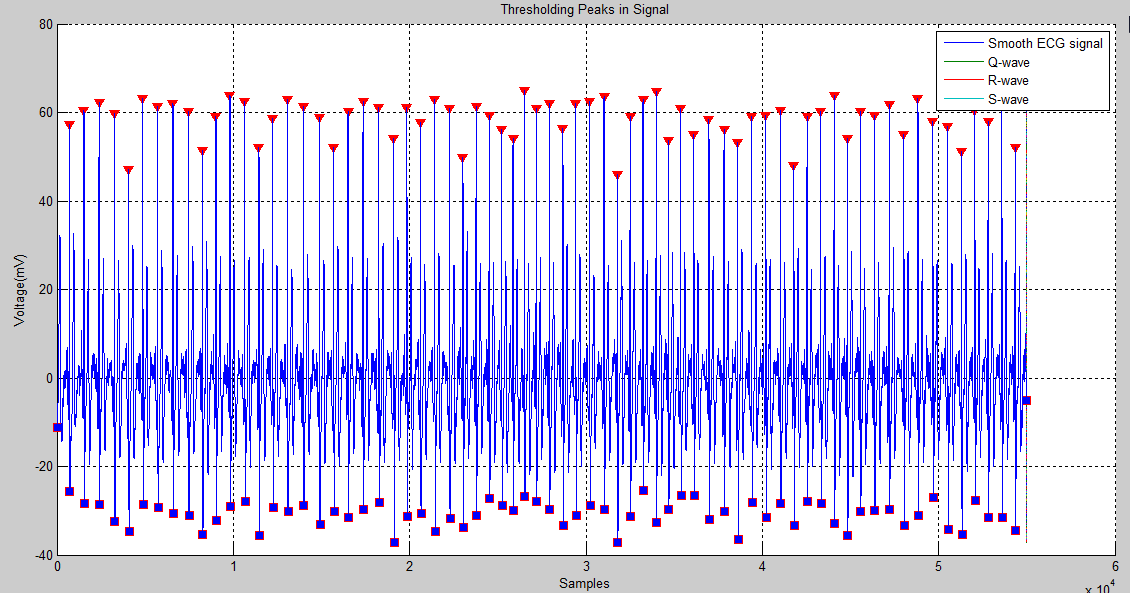 barpakl R peak and S peak detected , but not Q peak, the ECG peak
