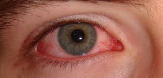 Cara mengatasi mata merah karena iritasi