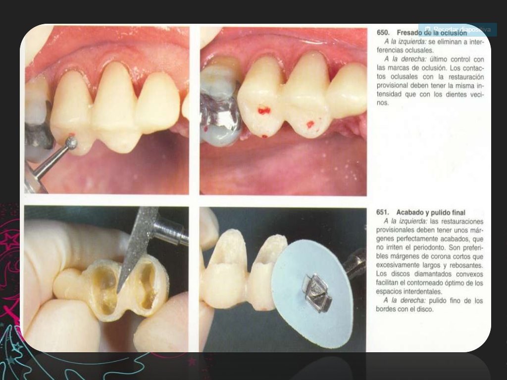 Provisionales dentales
