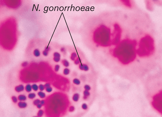 Pemeriksaan Neisseria gonorrhoeae
