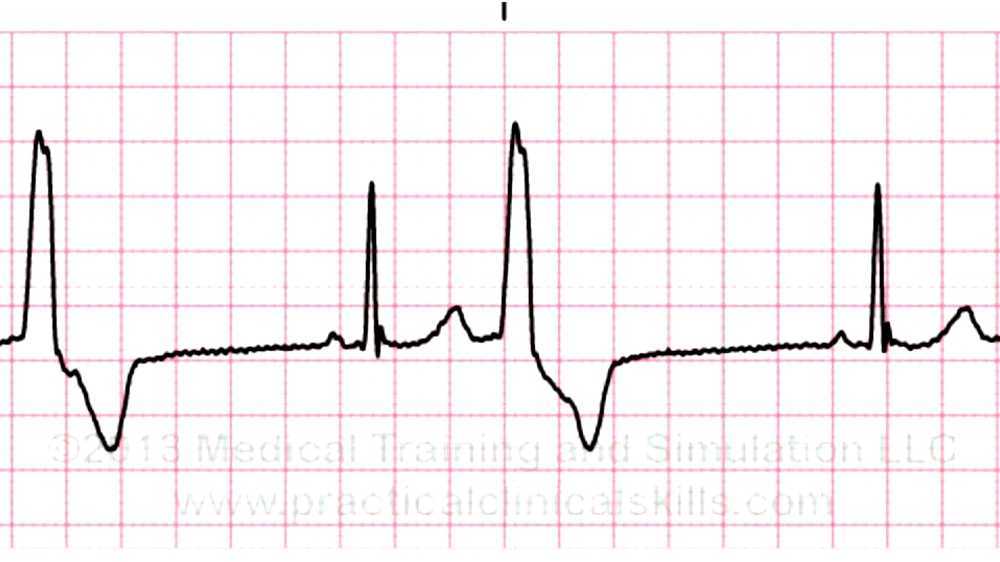 Premature ventricular contraction