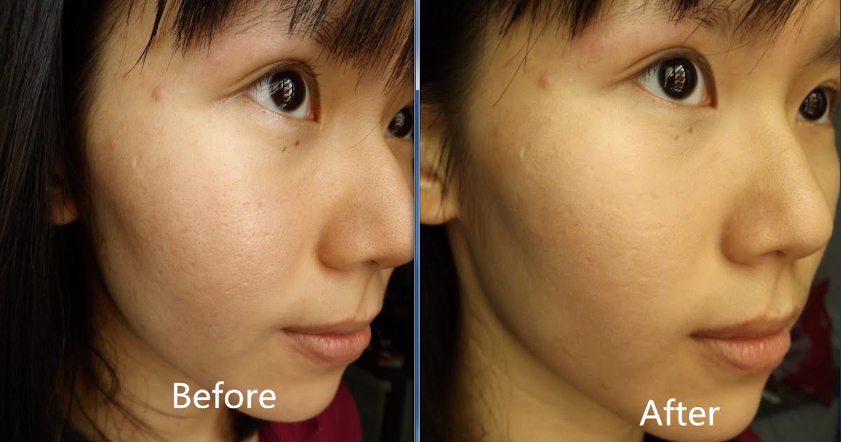How to Hide Acne Scars with Makeup - L'Oréal Paris