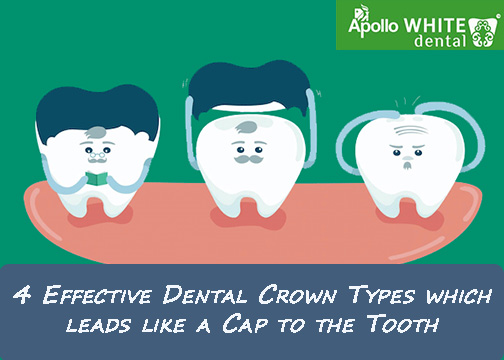  4 Effective Dental Crown Types which leads like a Cap to the Tooth