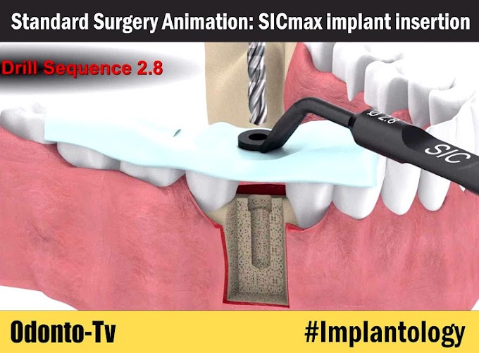 IMPLANTOLOGY: Standard Surgery Animation: SICmax implant insertion