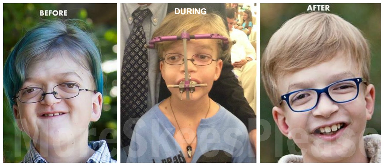 What Is the MidFace Advancement Surgery and the RED device?