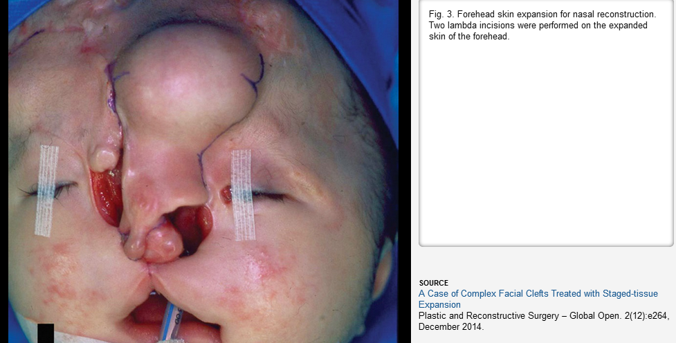 Facial Clefts And 7