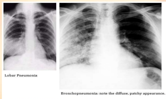 Bronkopneumonia adalah