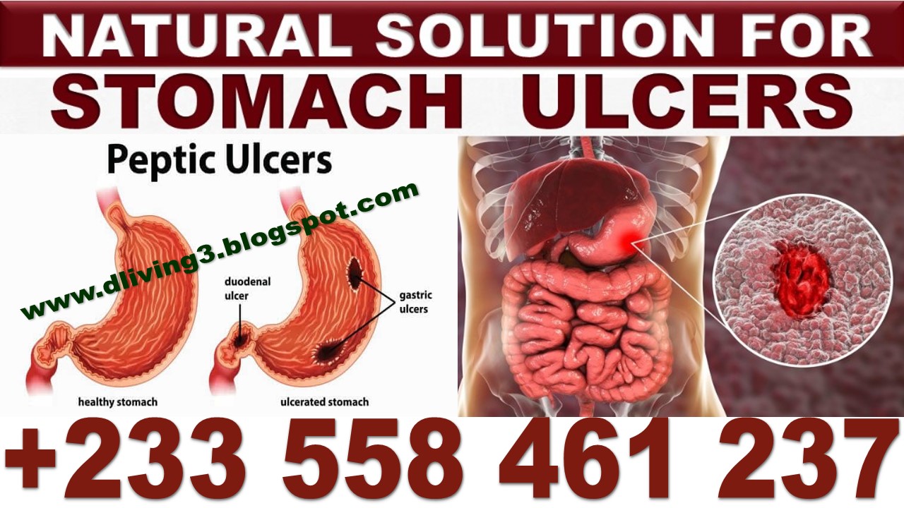 NATURAL REMEDY FOR  STOMACH ULCER
