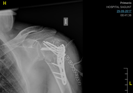 Radiografía de placa atornillada a humero izquierdo