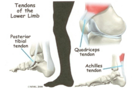 tendinitis