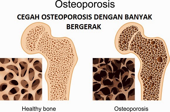 Cegah Osteoporosis Dengan Banyak Bergerak