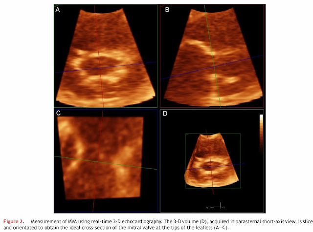 MVA Mitral Valve Area Measurement 3D echocardiography Mitral Stenosis