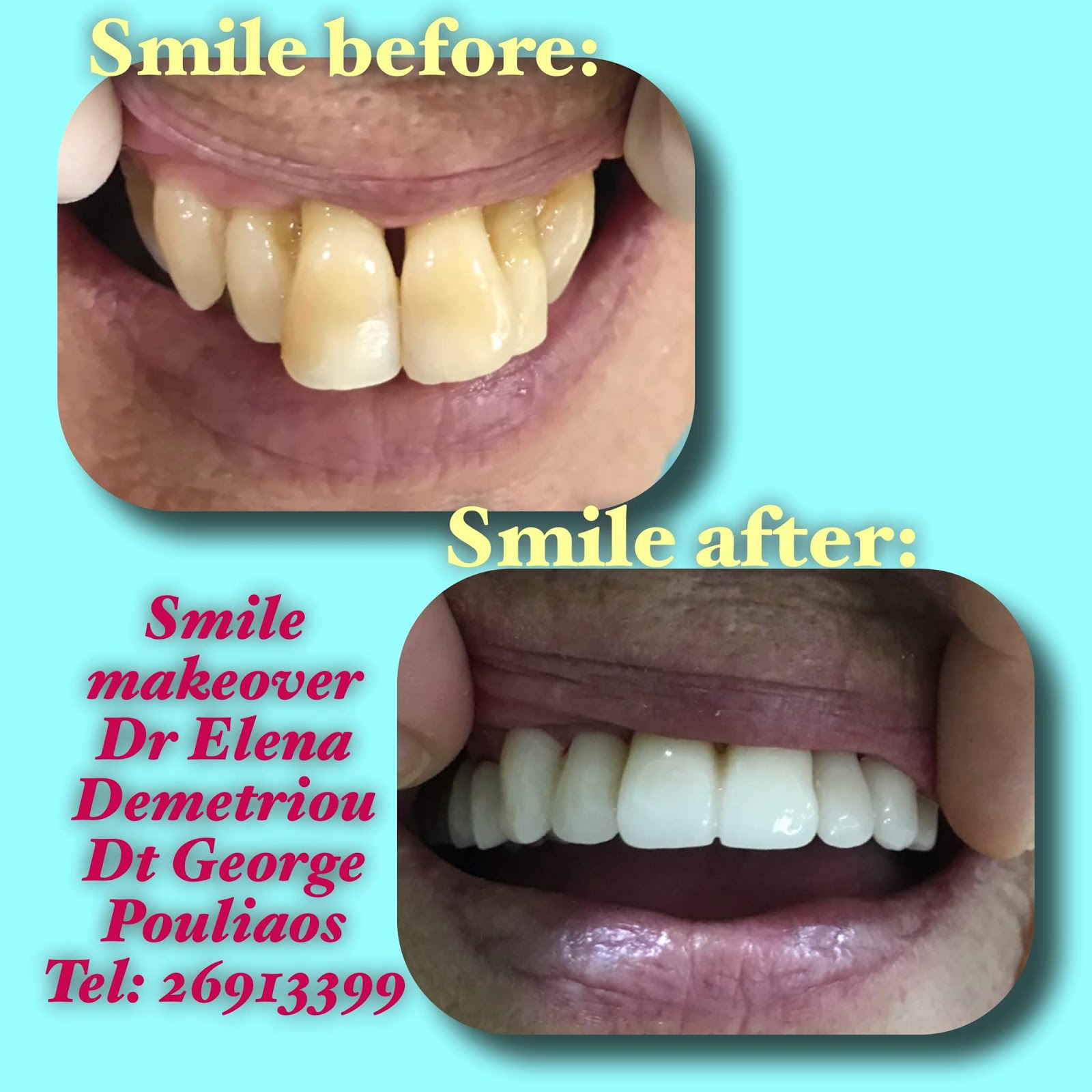 Paphos Dentist, Dr Elena Demetriou Examples of our work