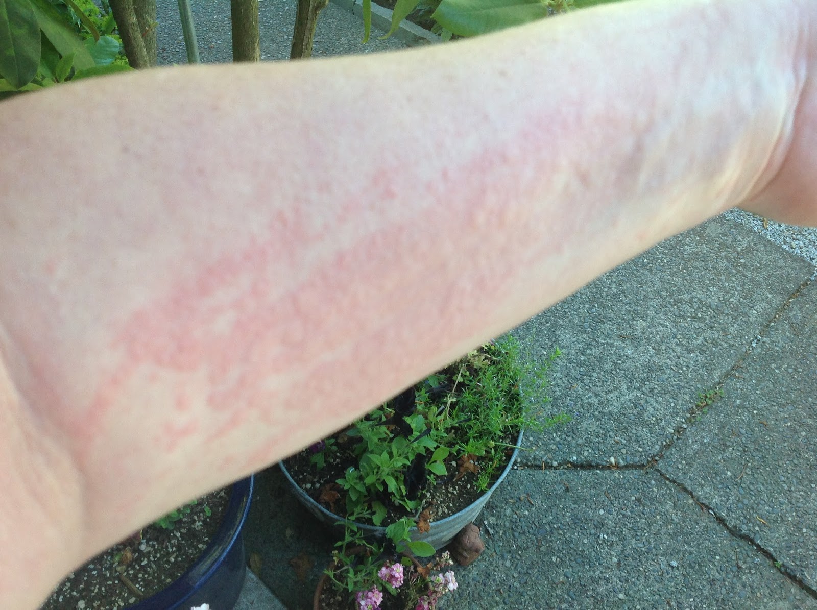 Badbatical Hives, Prednisone, and Sweet "No Thank You's"