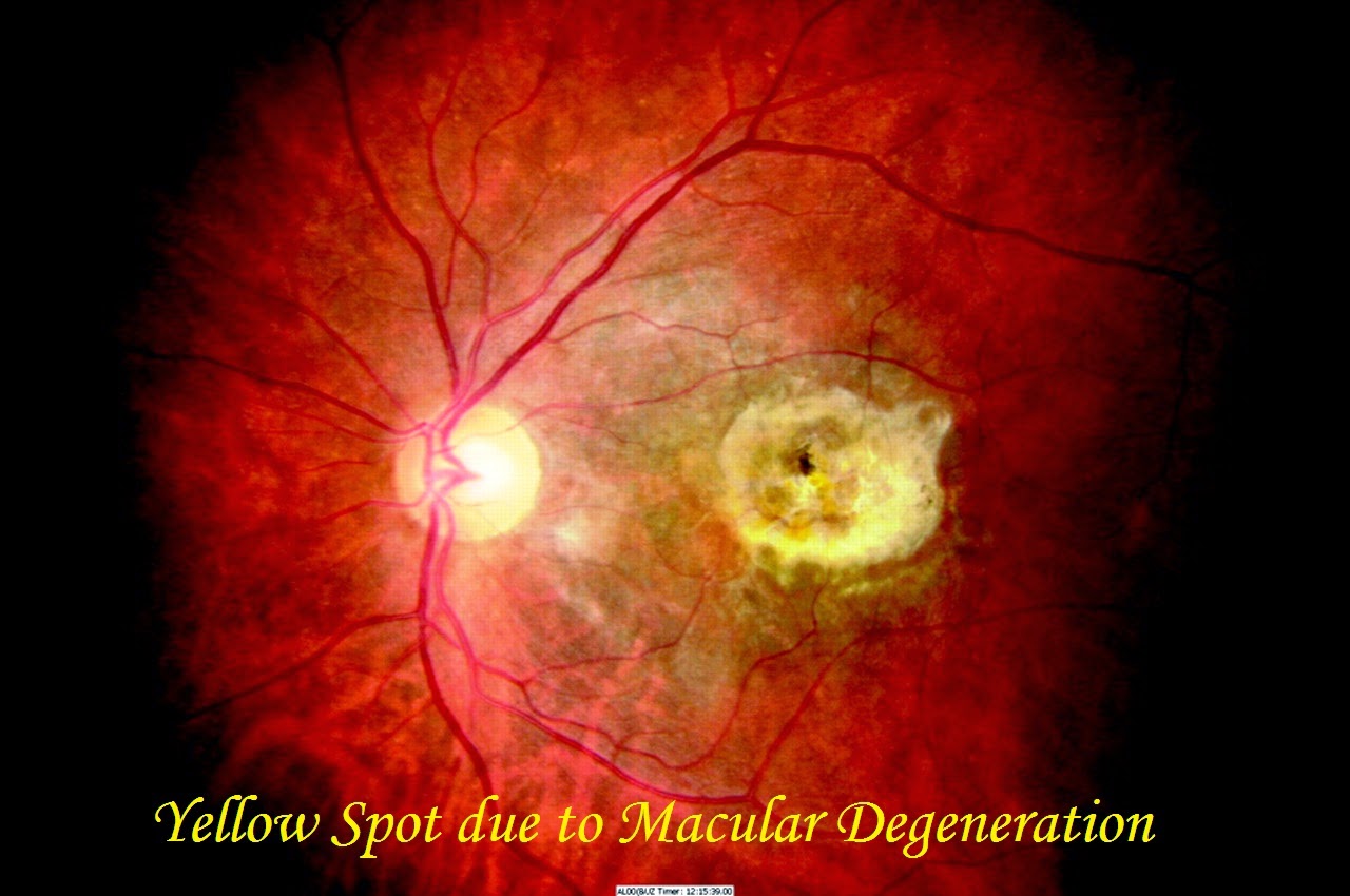 Treatment of Macular Degeneration by Ayurveda in Jaipur, India