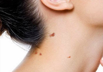 10 Effective Remedies To Remove Skin Tags