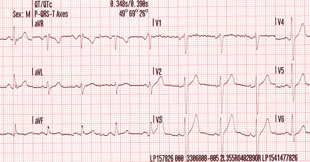 Iphone Ecg Case Iphone Ecg Case