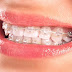 Ưu thế của kỹ thuật niềng răng sứ là gì mà nhiều người lựa chọn?
