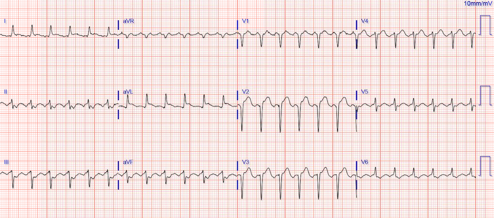 Typical Atrial Flutter And Ecg Ukrainesmash