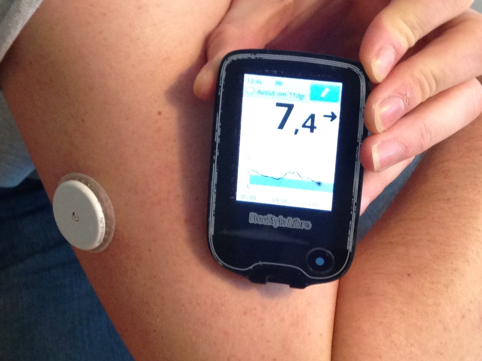 Continuous Glucose Monitoring Devices Market Share and Growth Factors