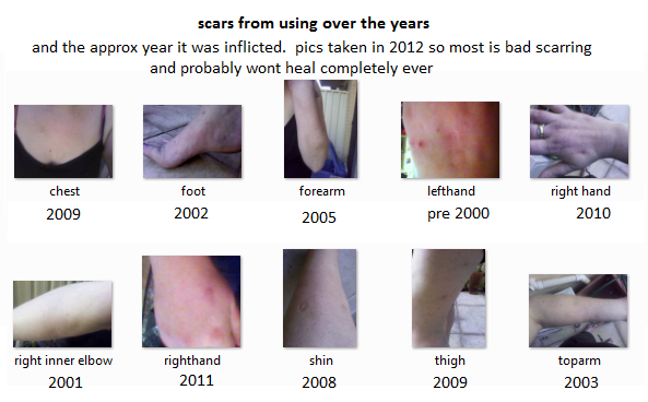 Life On Meth By An Almost 15 Year Meth Addict Scars And Bumps