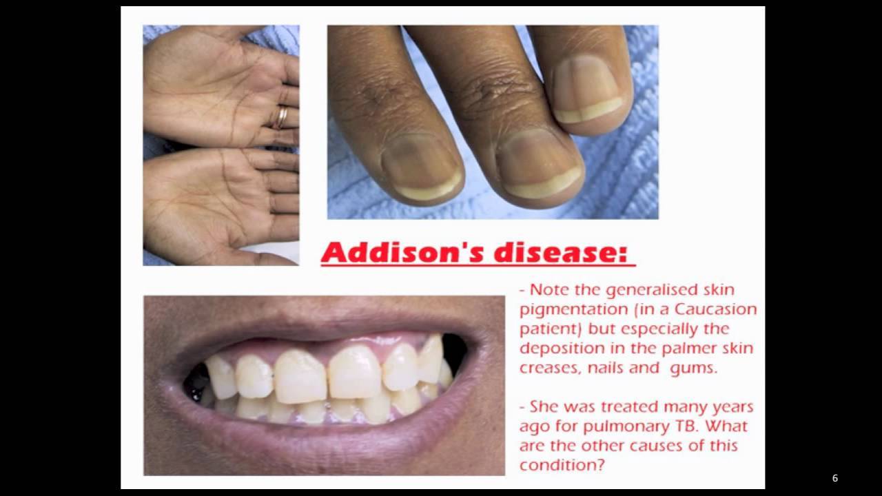 Addisons Disease Causes Risks Diagnosis And Treatment