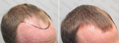 Hasil Pemakaian Kirkland untuk rambut botak dalam 1 bulan Hasil Pemakaian Kirkland untuk rambut botak dalam 1 bulan