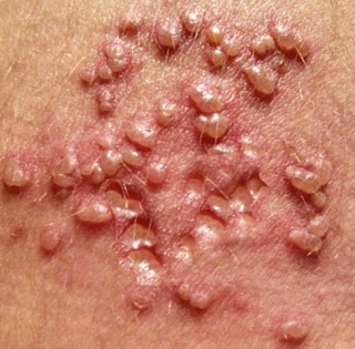 Obat ampuh buat dompo atau herpes cepat sembuh