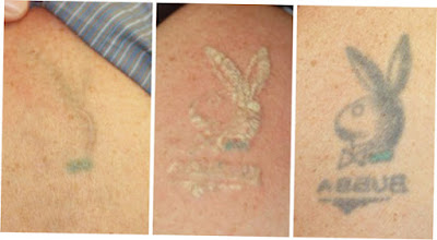 Tattoo Removal With Laser Picture 2 Preview