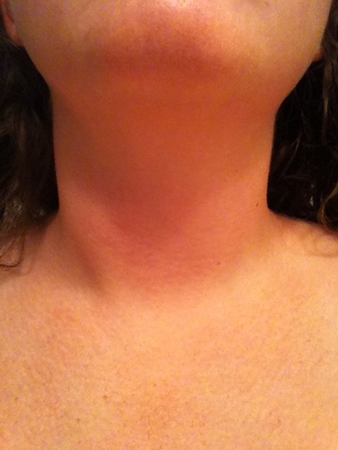 lump inside neck that moves