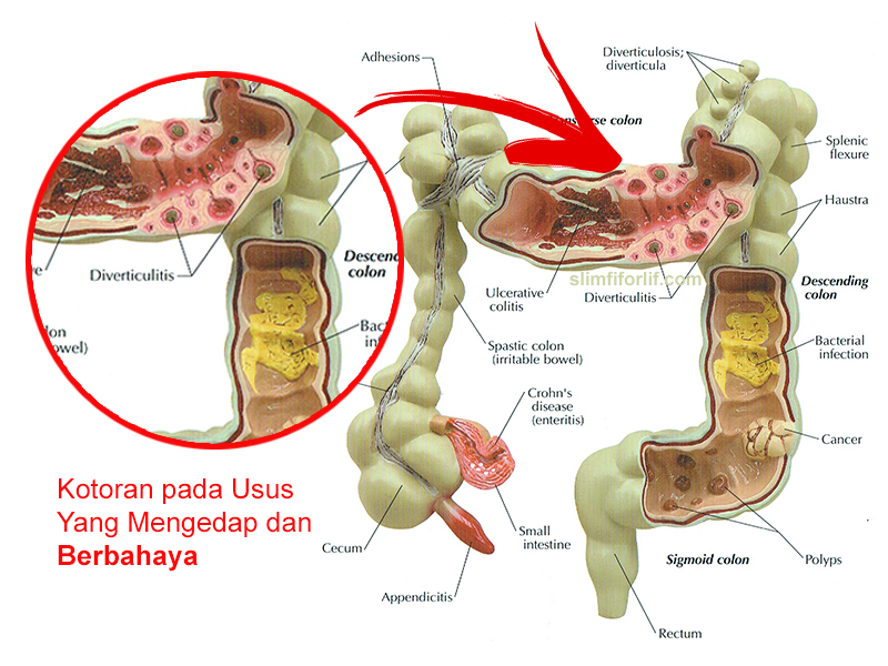 Foro colon irritable