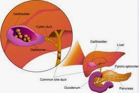 what causes gallstones