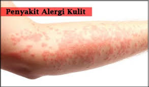 obat gatal alergi di apotik terbukti ampuh obat gatal alergi di apotik terbukti ampuh