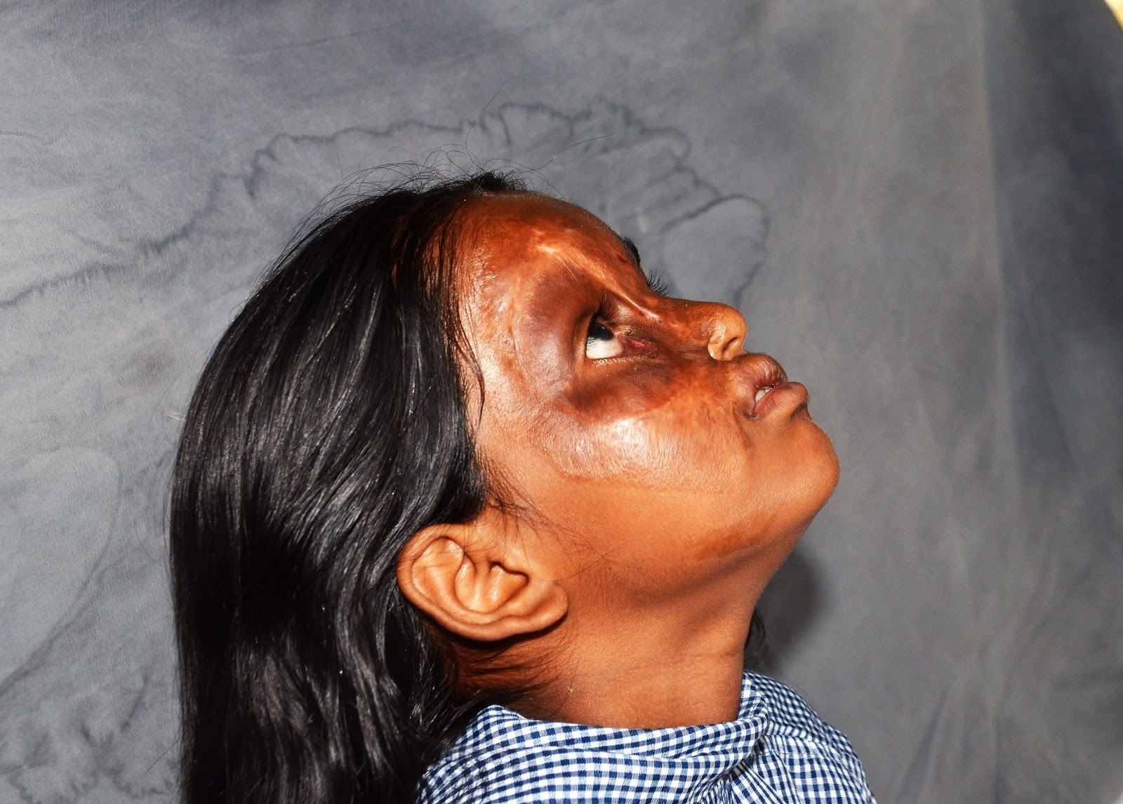 Burn Scarred Face
