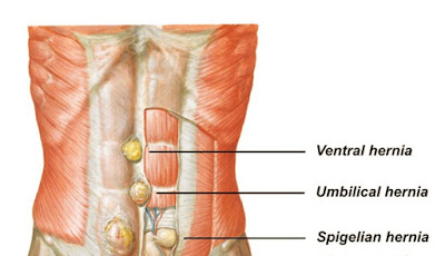 Spigelian hernia Pictures, Symptoms, Causes, Recovery, Repair