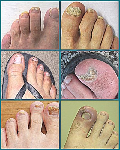 Vicks VapoRub for Toenail Fungus