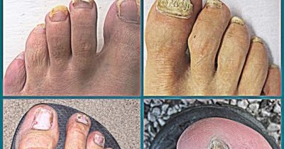 Healthy Lifestyle: Does Vicks VapoRub for Toenail Fungus Really Work?