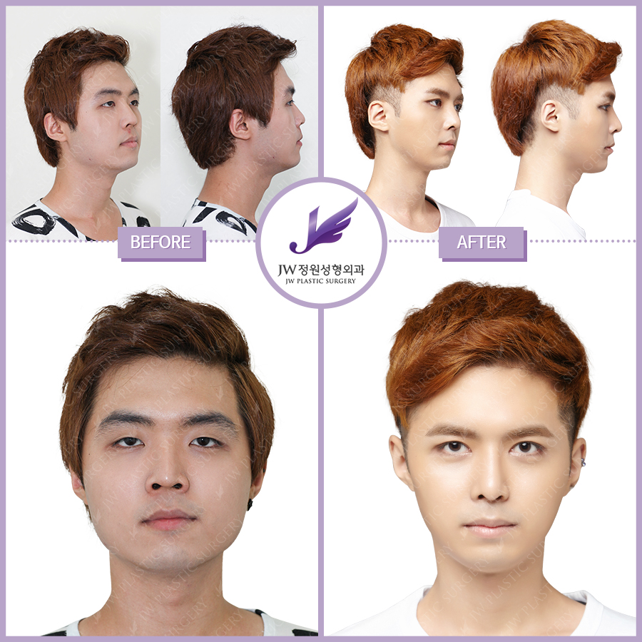 The Price for Male Plastic Surgery in Korea