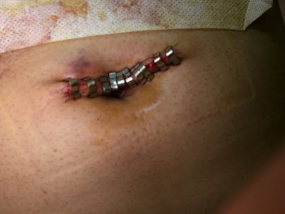 Incision uncovered for the 1st time – all the clips still attached