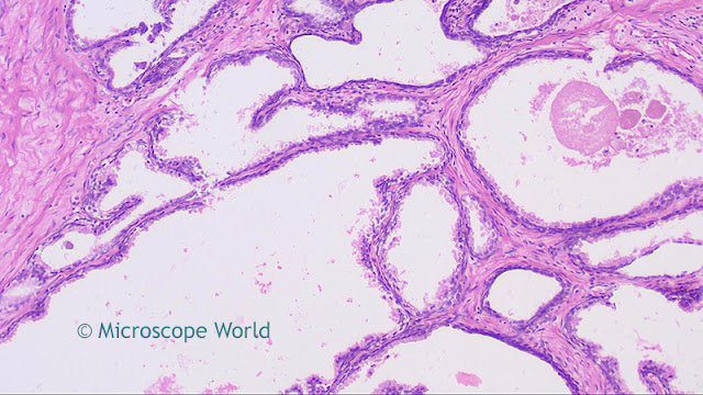 Lab microscope image of prostate cancer at 40x from MicroscopeWorld.com.