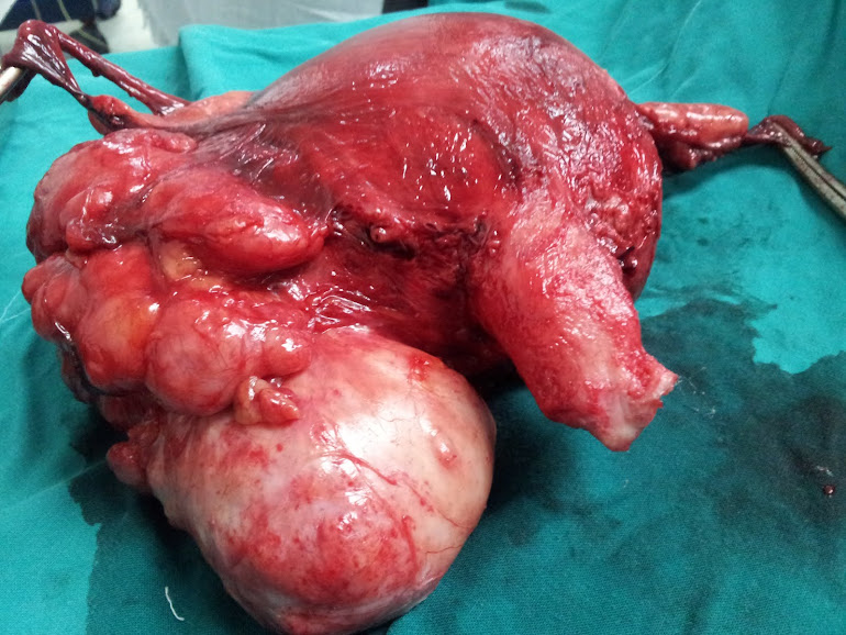 Large broad ligament fibroid - TAH and BSO done by Dr. Alaa Mosbah