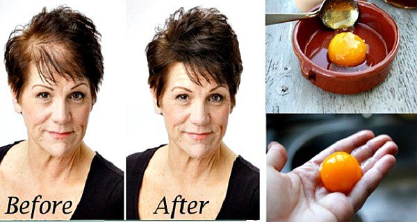 Health Remedies : You Have Lost Part of Your Hair? Here is How to Grow ...