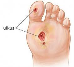 lp ulkus diabetes mellitus