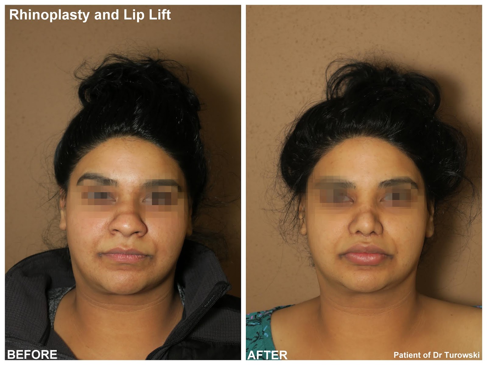 New Horizons Plastic Surgery Lip Lift and Rhinoplasty