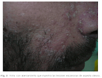 Dermatitis seborreica