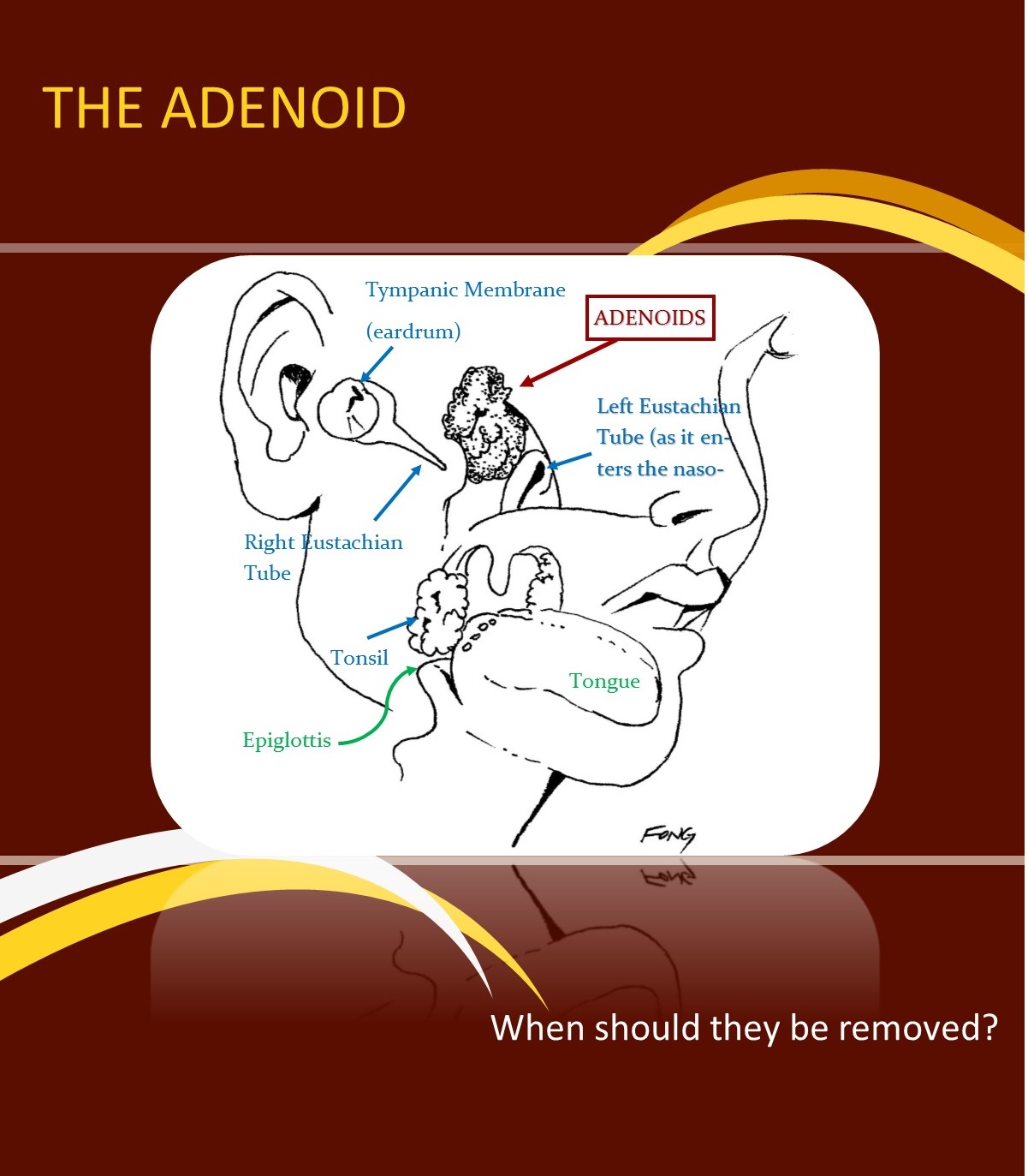 Adenoidectomy Indications