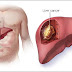 Important Things We Want You To Know About Liver Cancer