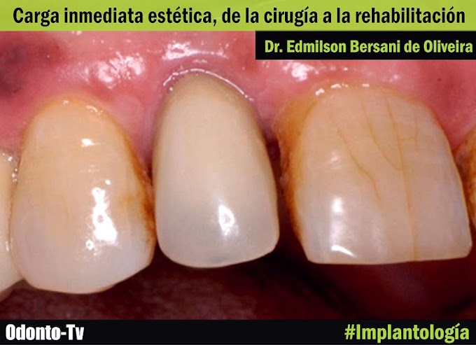 CARGA INMEDIATA: Implantología estética, de la cirugía a la rehabilitación - Dr. Edmilson Bersani de Oliveira