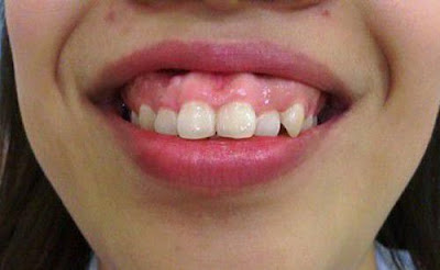 Điều trị khuyết điểm răng bị vẩu